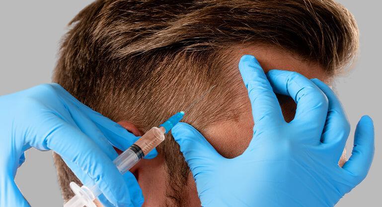 Hårtransplantation för vikar